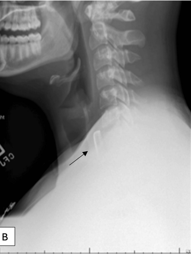 Ngilu! Penampakan Tutup Botol Nyangkut di Tenggorokan, Tak Sengaja Tertelan