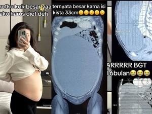 Viral Wanita Surabaya Idap Kista Sebesar 33 Cm, Inikah Pemicunya?