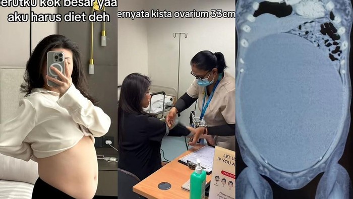 Wanita Surabaya idap kista ovarium 33 cm