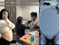 Dialami Wanita di Surabaya, Obgyn Beberkan Ciri-ciri Perut Buncit Akibat Kista