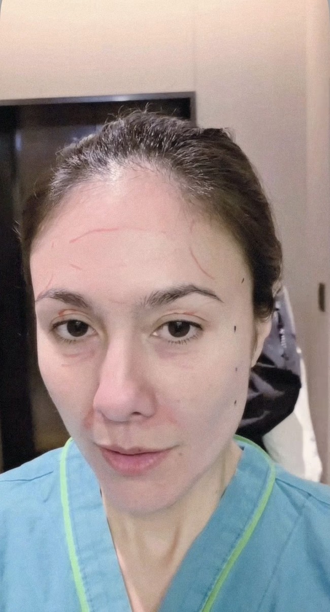 Wulan juga membagikkan foto wajahnya yang sudah diberi tanda untuk dikoreksi. Tampak bagian dahi, bawah mata, serta samping wajah yang sudah ditandai oleh dokter. Foto: Instagram/@wulanguritno