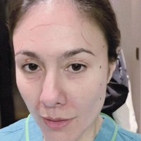 Wulan juga membagikkan foto wajahnya yang sudah diberi tanda untuk dikoreksi. Tampak bagian dahi, bawah mata, serta samping wajah yang sudah ditandai oleh dokter. Foto: Instagram/@wulanguritno