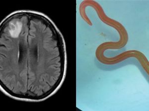 Ngeri, Dokter Temukan Cacing Parasit Ular Piton 8 Cm di Otak Wanita Australia