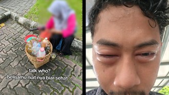 Viral Wajah Pria Bengkak Usai Minum Jamu Sachet, Ternyata Mengandung Ibuprofen