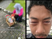 Viral Wajah Pria Bengkak Usai Minum Jamu Sachet, Ternyata Mengandung Ibuprofen