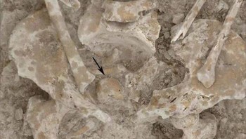 Sebuah massa yang mengeras dan kemudian diketahui sebagai tumor ditemukan di panggul jenazah wanita Romawi tersebut. Foto: Boredpanda