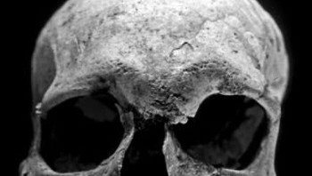 Penderita Kusta Pertama. Kusta adalah penyakit berat yang menyerang manusia; kusta umum terjadi pada periode Abad Pertengahan, seperti pada masa Raja Baldwin dari Yerusalem. Penderita kusta pertama yang pernah tercatat adalah 4000 tahun yang lalu, dan ini adalah tengkoraknya yang berhasil diselamatkan selama berabad-abad. Foto: Boredpanda