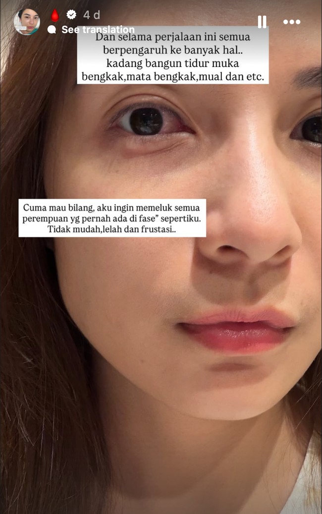 Bagian wajah Chelsea juga ikut terdampak. Seperti, bagian wajah dan matanya yang ikut bengkak saat bangun tidur. Foto: Instagram/@chelseaoliviaa