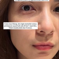 Bagian wajah Chelsea juga ikut terdampak. Seperti, bagian wajah dan matanya yang ikut bengkak saat bangun tidur. Foto: Instagram/@chelseaoliviaa