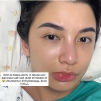 Setelah operasi, bibirnya sempat bengkak karena tanpa sadar tergigit olehnya selama proses operasi. Namun terlihat wajah Chelsea sudah kembali segar dan tetap glowing. Foto: Instagram/@chelseaoliviaa