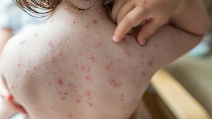 Kasus Campak di Indonesia Tertinggi Kedua di Dunia