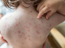 Campak Bukan Pembersihan Tubuh! Simak Fakta Medis dan Bahaya Komplikasinya