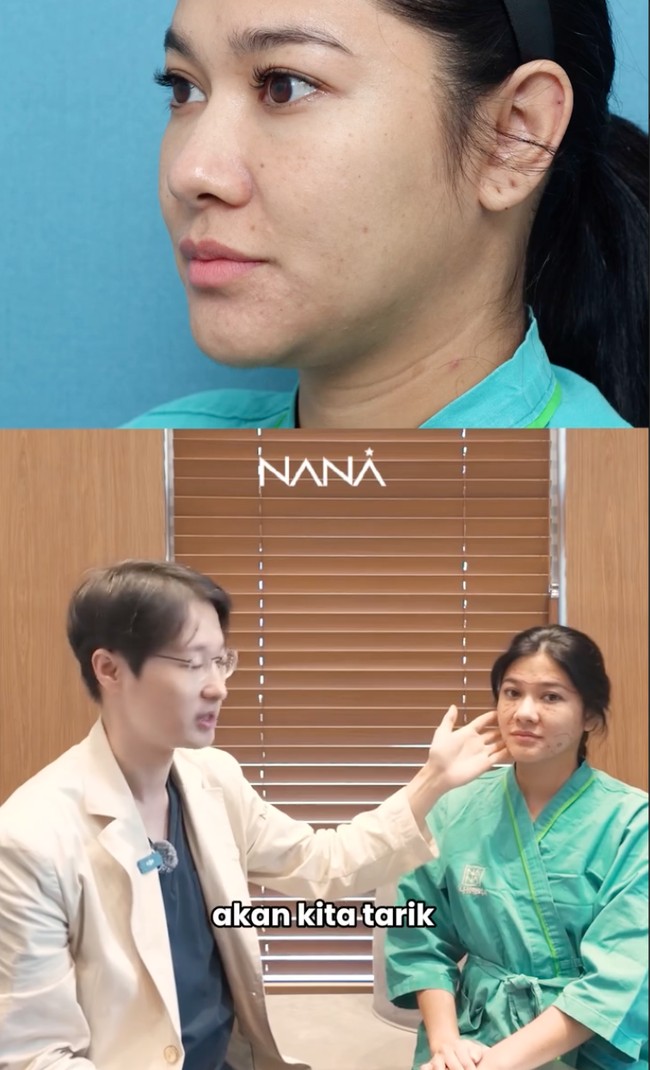 Face lift dilakukan untuk memperbaiki daerah rahang dan dagu Naysilla yang sudah mulai kendur. Selain itu beberapa bagian wajahnya juga akan menjalani liposuction untuk menyedot lemak dan membuatnya lebih tirus. Foto: Instagram/@nanahospital.id