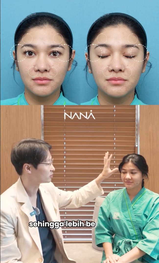 Sementara beberapa bagian wajah yang kurang bervolume akan diperbaiki dengan tindakan fat graft untuk membuat wajahnya terlihat semakin fresh dan awet muda. Foto: Instagram/@nanahospital.id