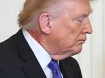 Muncul Ruam Merah di Leher Trump, Kesehatan Sang Presiden Disorot
