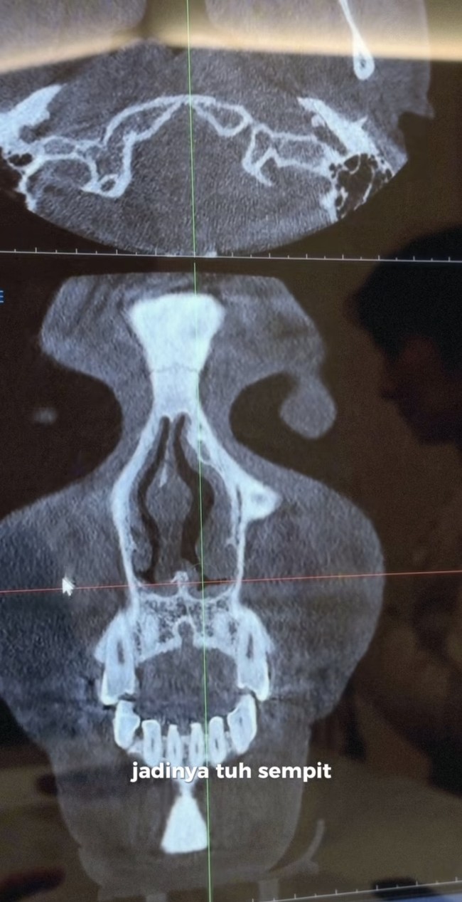 Sebelum tindakan, Shalom menjalani serangkaian pemeriksaan, salah satunya CT Scan bagian hidung. Dari hasil gambar yang dibagikan terlihat salah satu bagian hidungnya mengalami penyempitan akibat tulangnya yang bengkok, sehingga membuat Shalom tak bisa bernapas lega. Foto: Instagram/@sharazaaa