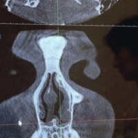 Sebelum tindakan, Shalom menjalani serangkaian pemeriksaan, salah satunya CT Scan bagian hidung. Dari hasil gambar yang dibagikan terlihat salah satu bagian hidungnya mengalami penyempitan akibat tulangnya yang bengkok, sehingga membuat Shalom tak bisa bernapas lega. Foto: Instagram/@sharazaaa