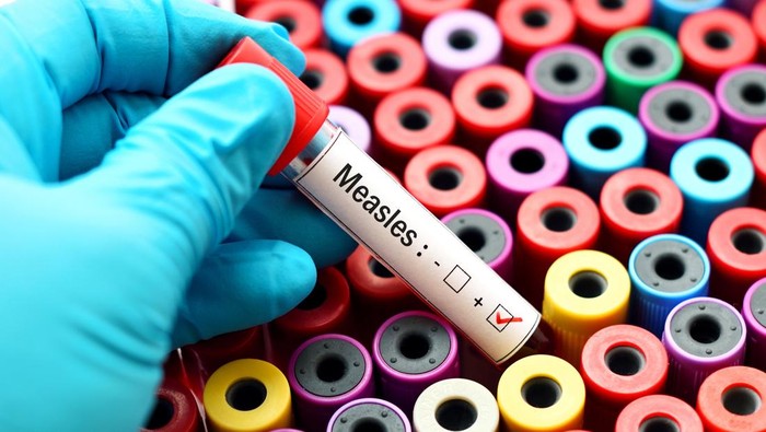 Blood sample positive with Measles virus