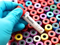 Kemenkes Soroti Influencer Keluyuran Saat Campak, Sarankan Ini Jika Telanjur Kontak