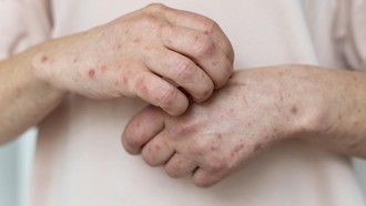 Potensi Lonjakan Kasus Jelang Lebaran, Kemenkes: Suspek Campak Jangan ke Mana-mana Dulu