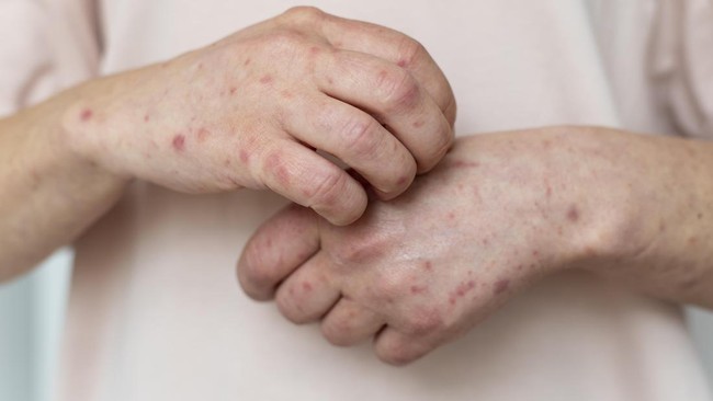 Kasus Positif Campak di Jabar Melonjak, Warga Diminta Waspada Saat Mudik