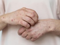 Apa Bedanya Campak dan Cacar? Ketahui Ciri dan Cara Mencegahnya