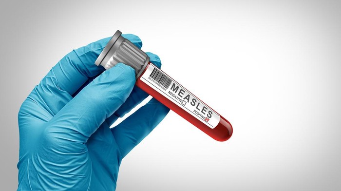 Measles Diagnosis as a Doctor or nurse holding a virus positive Blood collection tube or vacutainer as a symbol for infectious viral disease outbreak as a medical public health concern.