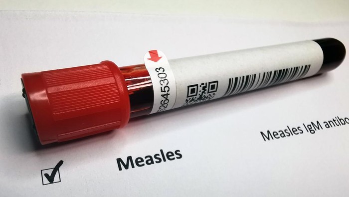 This image displays a vial for Measles IgM antibody testing, crucial for diagnosing Measles, an acute viral respiratory illness. The test detects IgM antibodies indicating recent infection. Measles is known for symptoms like a red, blotchy rash, feve