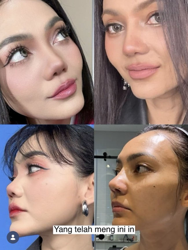 Dari samping tampak jelas perbedaan bentuk hidungnya sebelum dan setelah operasi. Di keterangan unggahan Rina juga menulis bahwa proses pemulihan operasi hidung yang dijalaninya itu umumnya memakan waktu 6 hingga 12 bulan. Foto: Instagram/@rinanose16