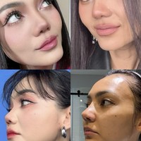 Dari samping tampak jelas perbedaan bentuk hidungnya sebelum dan setelah operasi. Di keterangan unggahan Rina juga menulis bahwa proses pemulihan operasi hidung yang dijalaninya itu umumnya memakan waktu 6 hingga 12 bulan. Foto: Instagram/@rinanose16