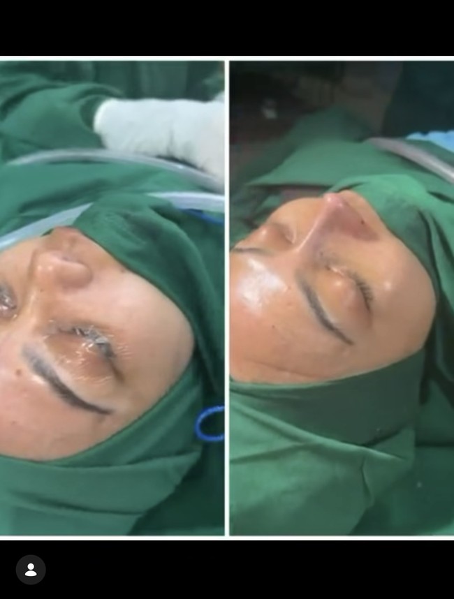 Wanita 42 tahun itu mengungkapkan bahwa keputusan rhinoplasty akhirnya ia ambil usai pertimbangan panjang yang dilaluinya, mengingat dirinya juga yang banyak dikenal karena trade mark hidung. Foto: Instagram/@rinanose16
