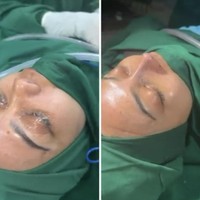 Potret Rina Nose Jalani Oplas Hidung di Indonesia, Begini Hasilnya