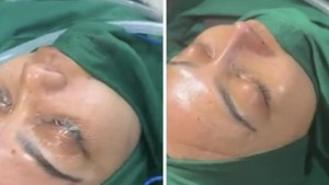 Potret Rina Nose Jalani Oplas Hidung di Indonesia, Begini Hasilnya