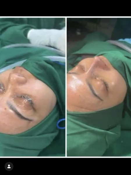 Potret Rina Nose Jalani Oplas Hidung di Indonesia, Begini Hasilnya