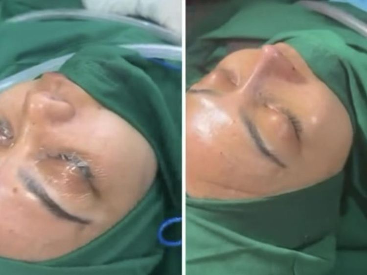 Potret Rina Nose Jalani Oplas Hidung di Indonesia, Begini Hasilnya