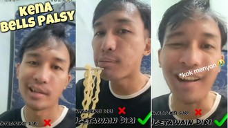 Viral Pria Idap Bell's Palsy, Bikin Mulutnya Miring ke Satu Sisi
