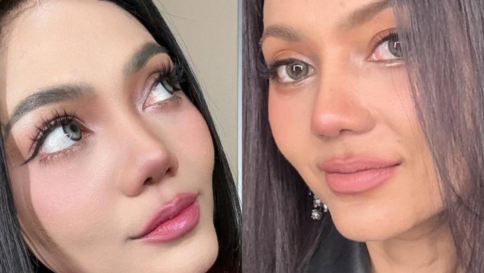 Rina Nose Perlihatkan Before-After Hidung Usai Oplas, Pangling Gak?