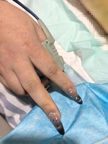 Kisah Wanita Hampir Kehilangan Nyawa Karena Manikur Gel