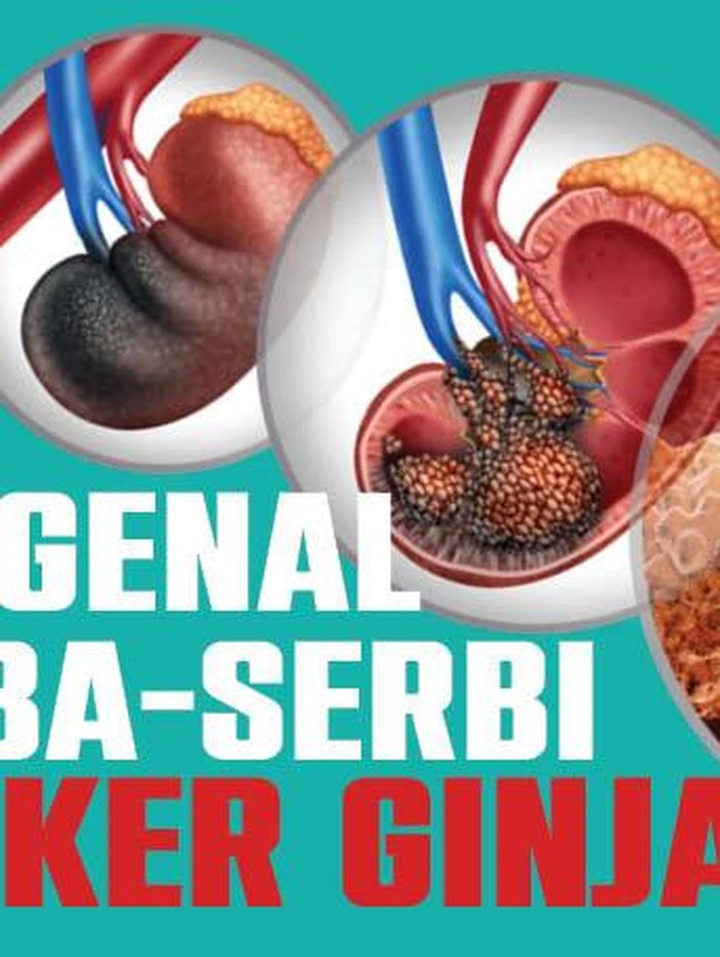 Waspadai Kanker Ginjal, Pola Makan Seperti Ini Bisa Tingkatkan Risiko