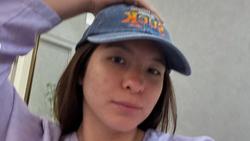 Detik-detik Shalom Razade Operasi Plastik, Hidung Dicoret-coret Dokter