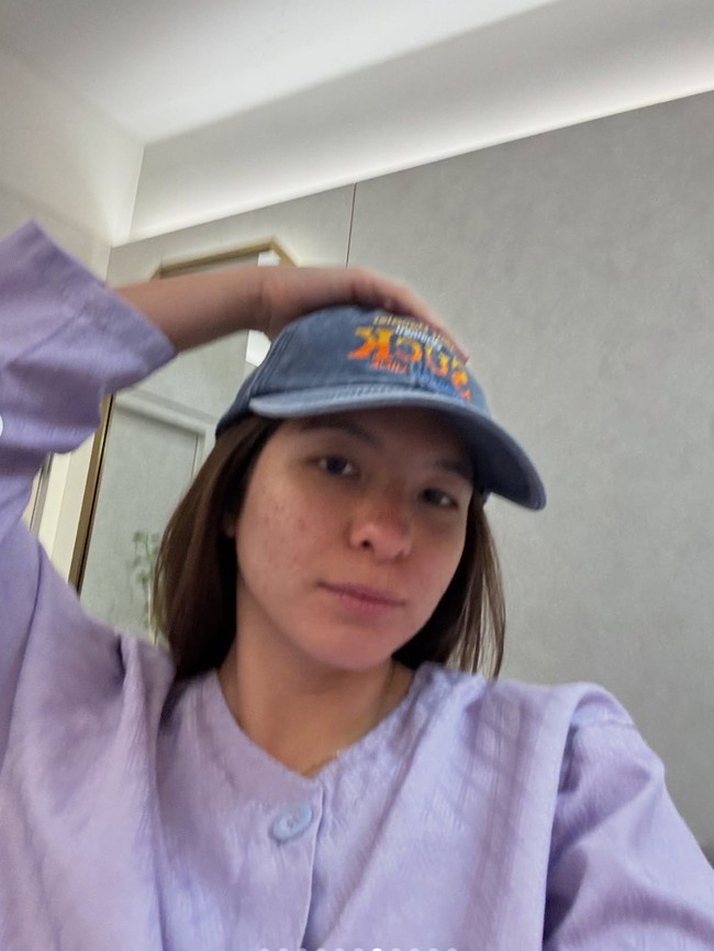 Detik-detik Shalom Razade Operasi Plastik, Hidung Dicoret-coret Dokter