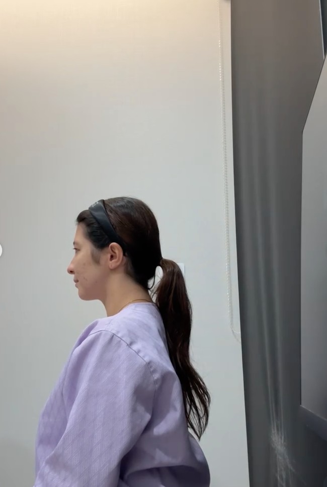 Shalom mengaku merasa deg-degan saat menunggu operasi plastik pertamanya itu. “nunggu masuk ruang operasi cuma dag dig dug dag dig dug. tegang banget karena ini operasi pertama di hidup aku, jd kepala udah kemana-mana,” tulisnya. Sebelum tindakan, wajah Shalom juga tampak difoto untuk nantinya dibandingkan dengan wajahnya setelah operasi. Foto: Instagram/@sharazaaa