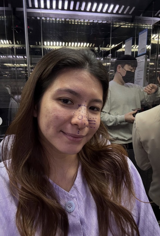 Shalom memamerkan hidungnya yang sudah penuh dengan coretan. Coretan-coretan tersebut menandai bagian yang nantinya akan dikoreksi di ruang operasi. Foto: Instagram/@sharazaaa