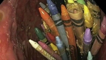 Wanita 27 tahun (skizoafektif) datang dengan mual, muntah, nyeri perut. CT scan: lesi di lambung. Endoskopi: ditemukan 81 krayon utuh + pena di lambung. Semua berhasil dikeluarkan via endoskopi. Pasien pulih dan kembali ke RSJ. Foto: Boredpanda