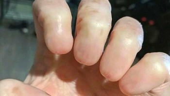 Bisakah Anda membayangkan tidak memiliki kuku jari? Anonychia, juga dikenal sebagai anonychia kongenital atau tidak adanya kuku kongenital, adalah kondisi langka yang ditandai dengan tidak adanya kuku saat lahir atau pengurangan ukuran kuku yang parah. Meskipun hanya memengaruhi sebagian kecil populasi, dampaknya pada penampilan fisik dan fungsi dapat signifikan. Foto: Boredpanda