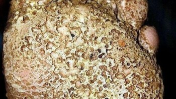 Kasus parah dari kondisi yang disebut keratolysis berlubang! Keratolysis berlubang adalah infeksi bakteri superfisial pada kulit yang menyerang telapak kaki, dan lebih jarang, telapak tangan. Ini adalah salah satu penyebab bau kaki. Ciri khasnya adalah kulit keputihan dan kelompok lubang-lubang kecil. Foto: Boredpanda