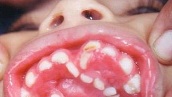 Kasus langka seorang anak yang menderita kondisi yang disebut hiperdontia. Hiperdontia adalah kondisi di mana seseorang memiliki gigi supernumerary atau lebih banyak gigi daripada biasanya yang dapat muncul di area mana pun dari lengkung gigi dan dapat memengaruhi organ gigi mana pun. Foto: Boredpanda