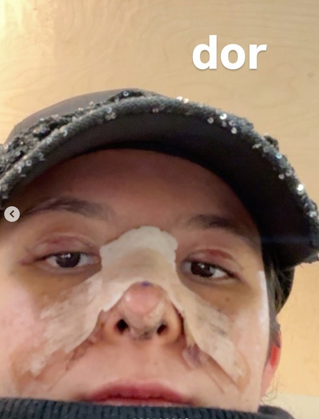 Di slide terakhir dalam unggahannya barulah terlihat wajah Shaloom dengan mata bengkak dan hidung yang masih diperban. Foto: Instagram/@sharazaaa