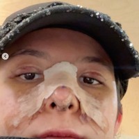 Di slide terakhir dalam unggahannya barulah terlihat wajah Shaloom dengan mata bengkak dan hidung yang masih diperban. Foto: Instagram/@sharazaaa