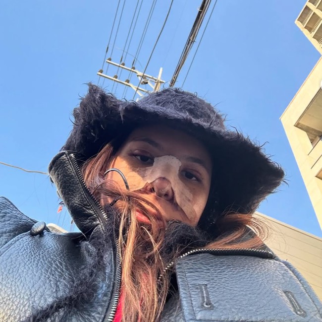 Potret Shaloom Razade Setelah Oplas, Wajah Masih Bengkak & Hidung Diperban